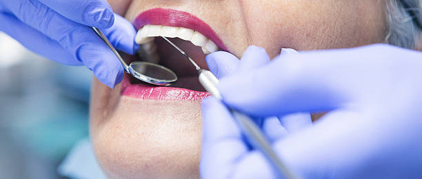 Best Teeth Whitening  in Mount Vernon, IA